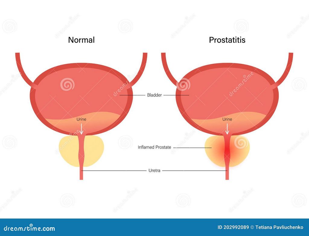 Los métodos más eficaces para tratar la prostatitis